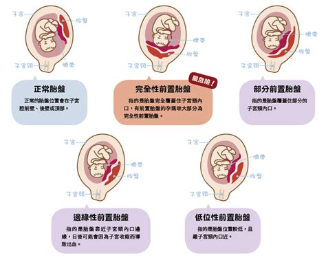 植入性胎盤是什麼